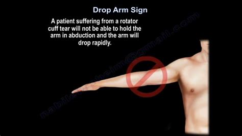 rotator cuff arm drop test|full thickness rotator cuff drop.